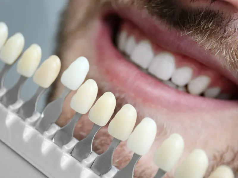 Porcelain Veneers at 3D Dental in Mastic, NY