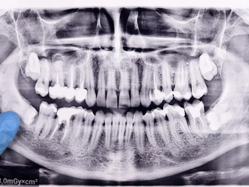 Wisdom Tooth Removal at 3D Dental in Mastic, NY